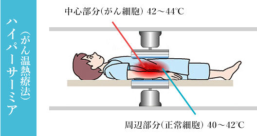 ハイパーサーミア